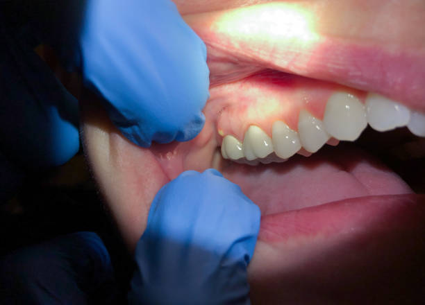Best Emergency Gum Treatment in Yaphank, NY